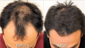 NeoGraft Hair Restoration Before and After Image