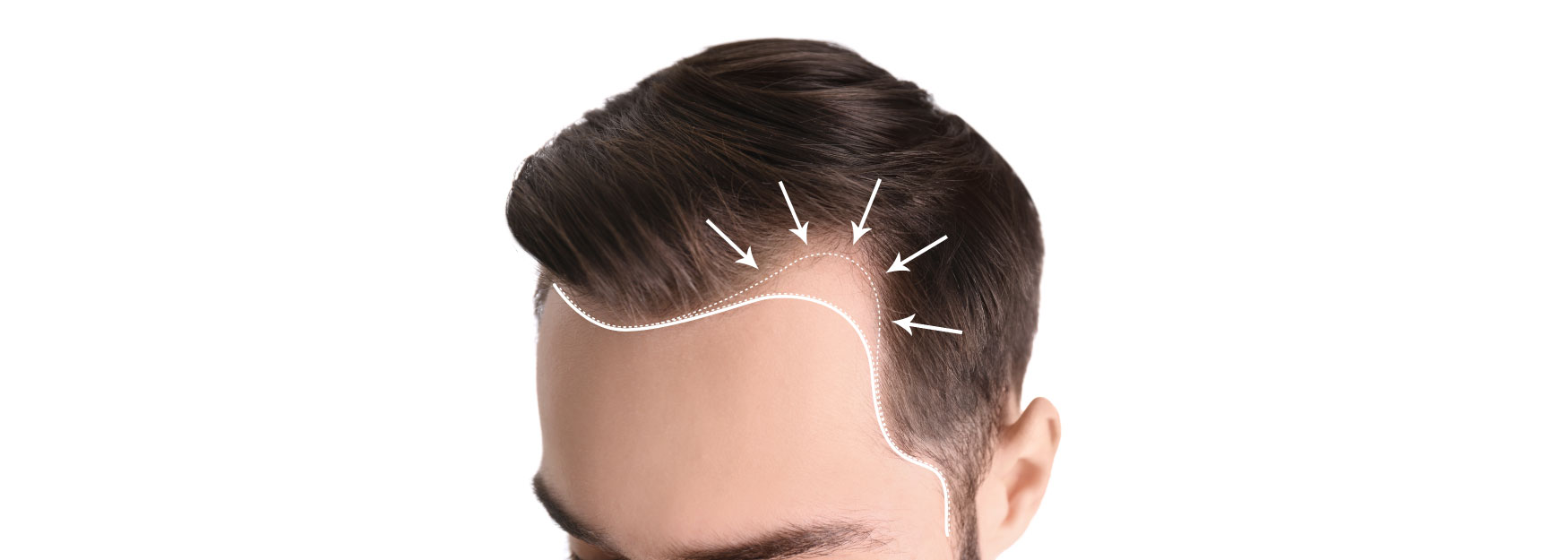 The 12 Top Natural Hair Restoration Techniques To Treat Hair Loss Image